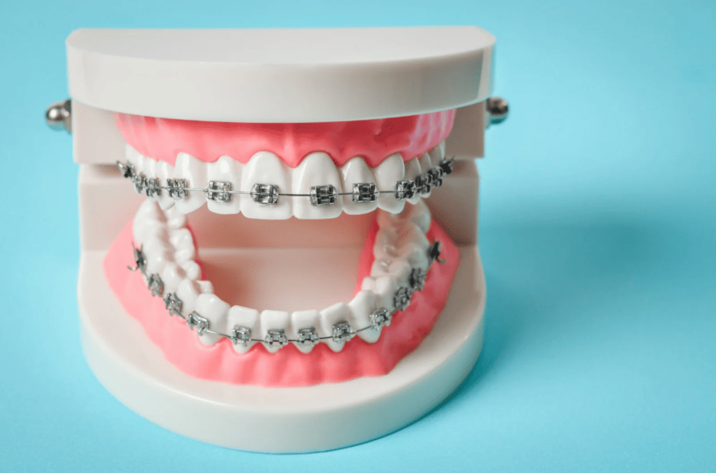 Braces Orthodontics Guide 箍牙詳盡指南