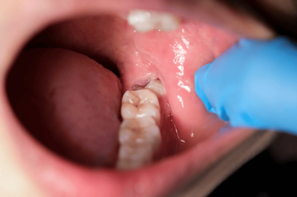 Causes of a Dental Abscess 牙瘡成因