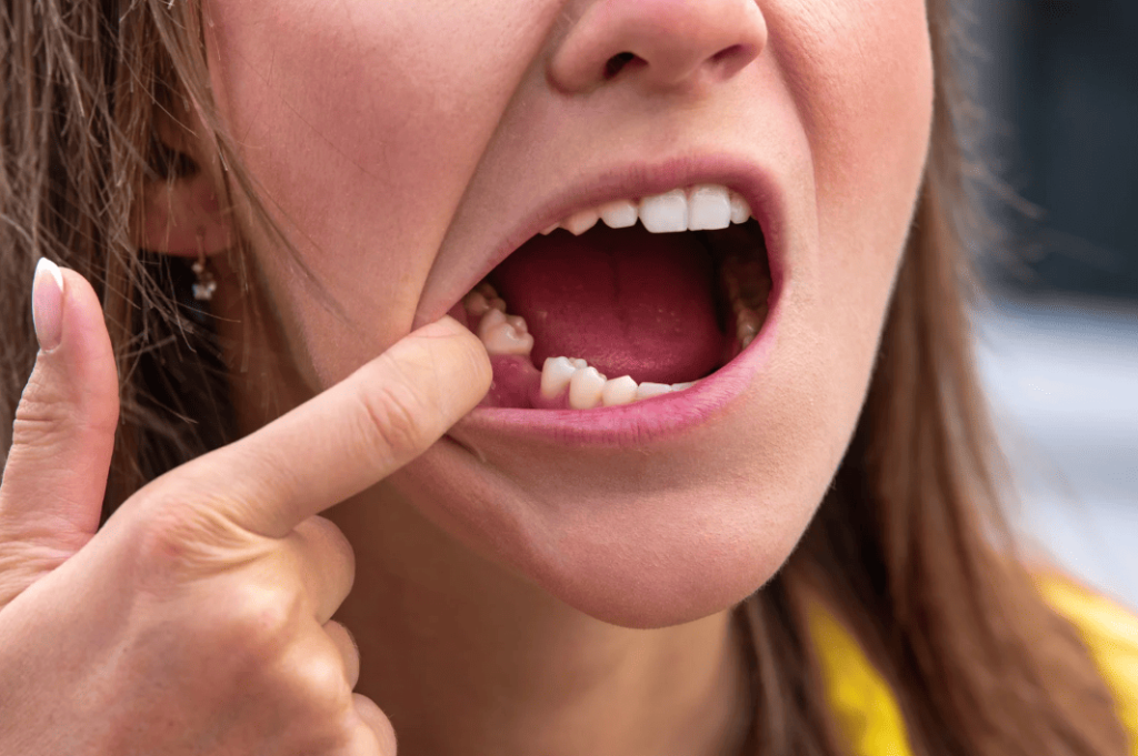 Consequences of Missing Teeth 甩牙後果