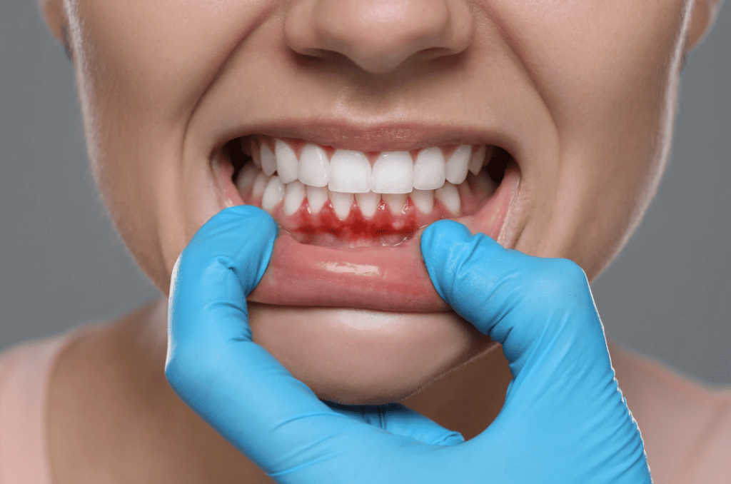 Dental Abscess 牙瘡