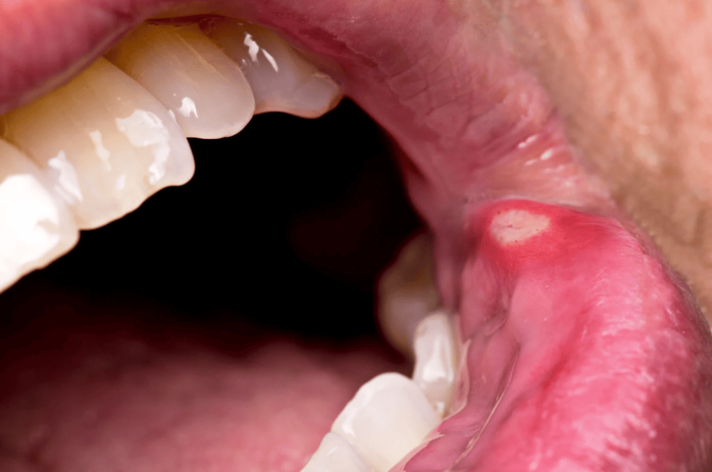 Dental Abscess and a Canker Sore 牙瘡與痱滋的分別