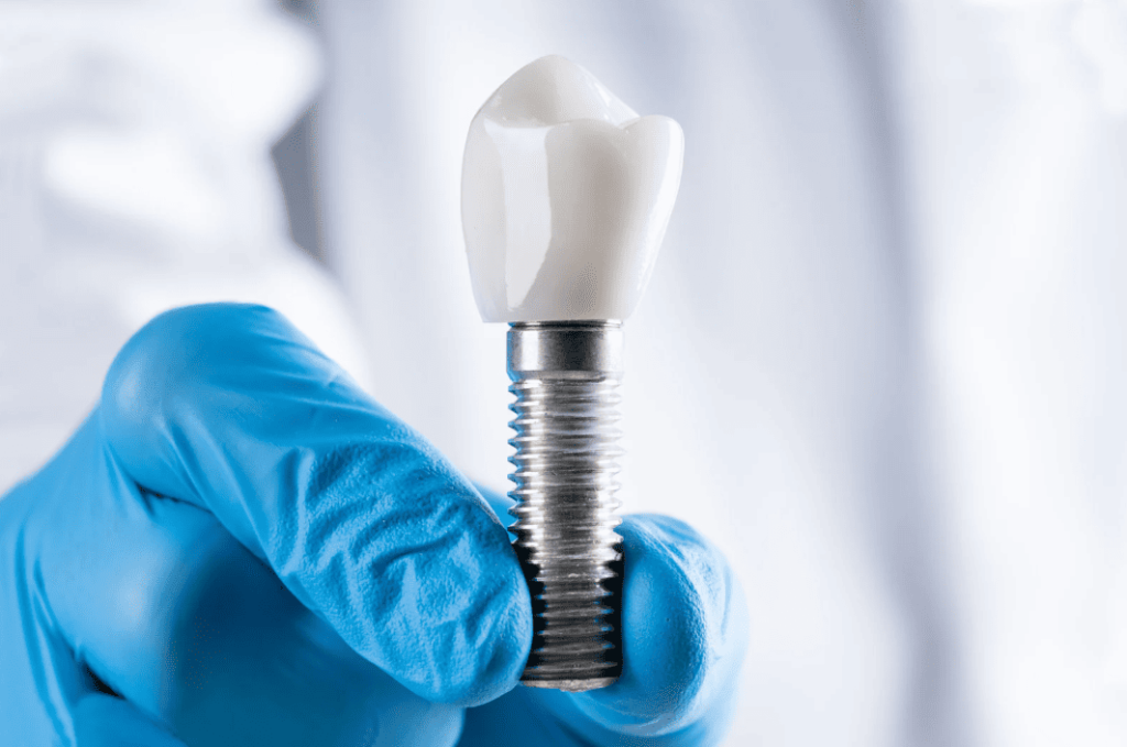 Dental Implants 種牙植牙