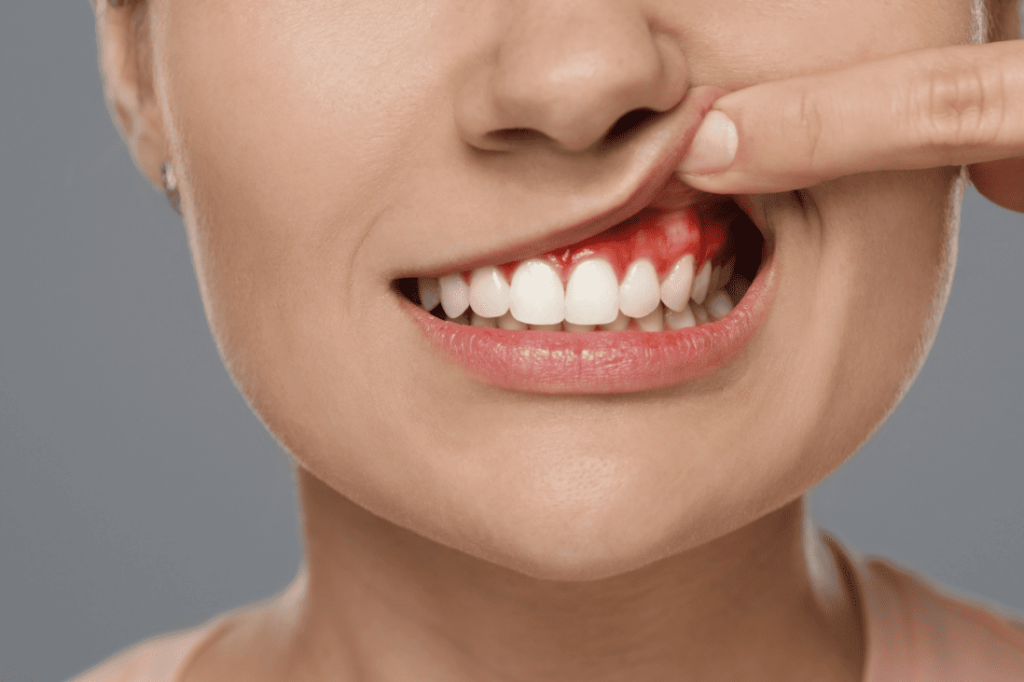 Diagnosis of Gum Disease 診斷牙周病