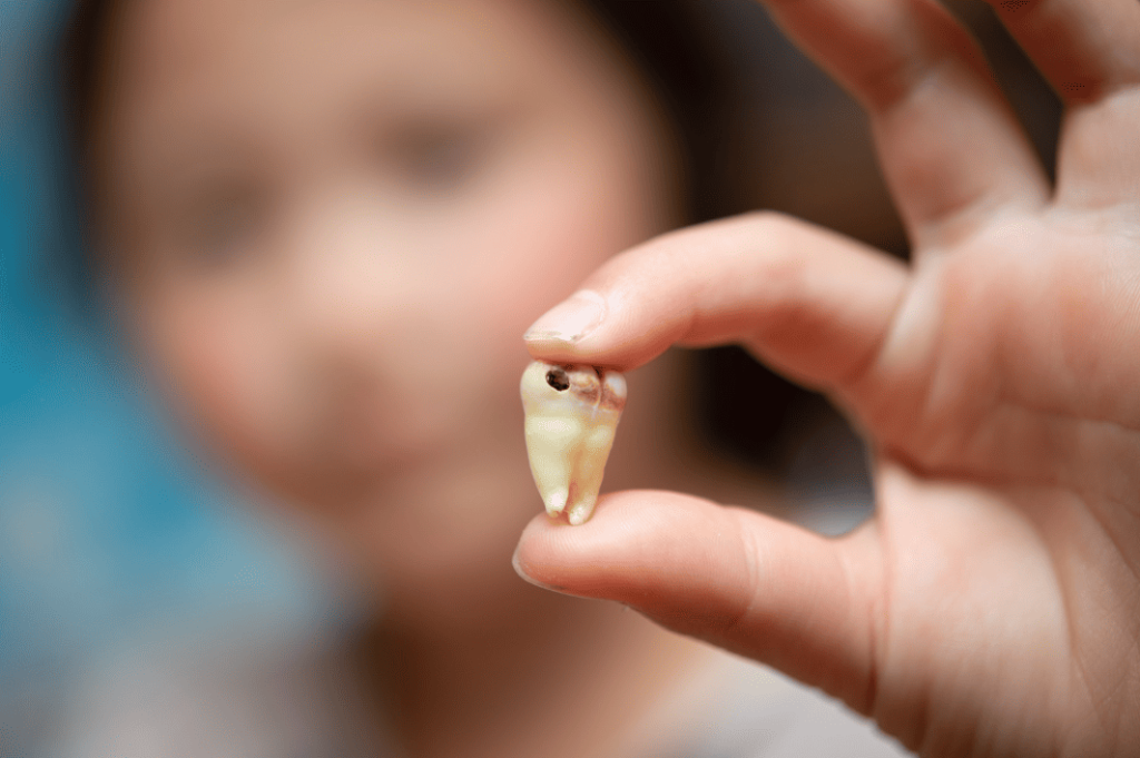 Different Stages of Tooth Decay 蛀牙的不同階段