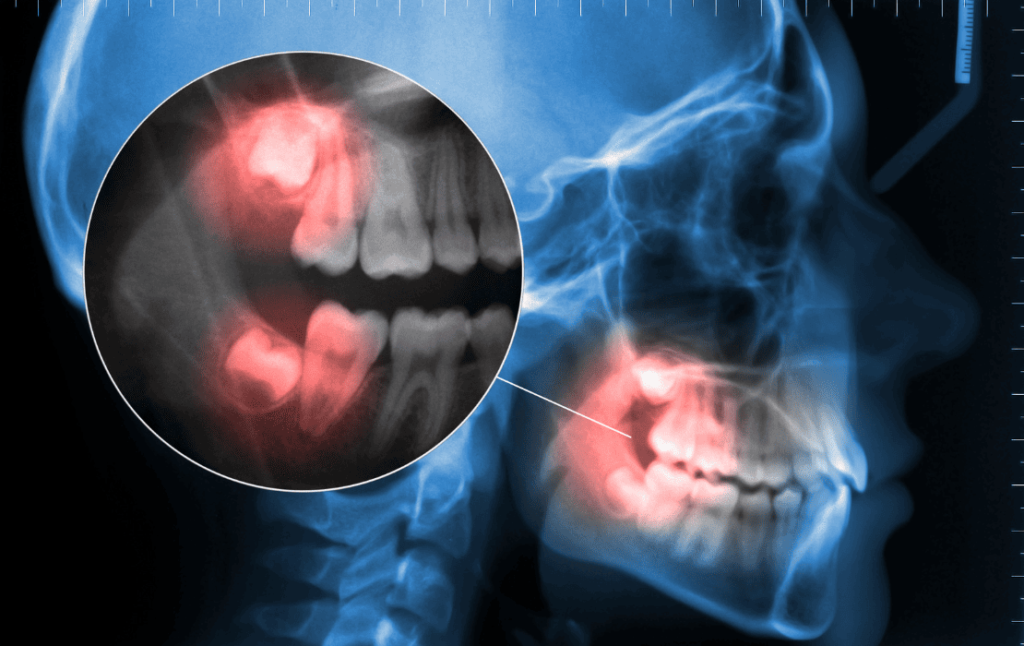 Fast Toothache Relief Methods 牙痛快速止痛方法