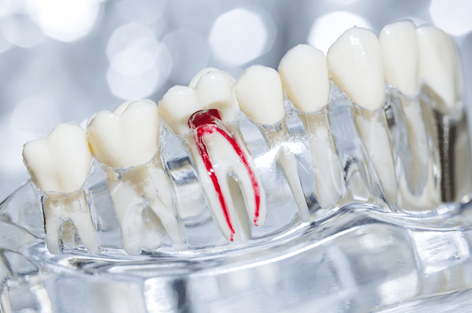 Guide to Root Canal Treatment 全面了解杜牙根治療