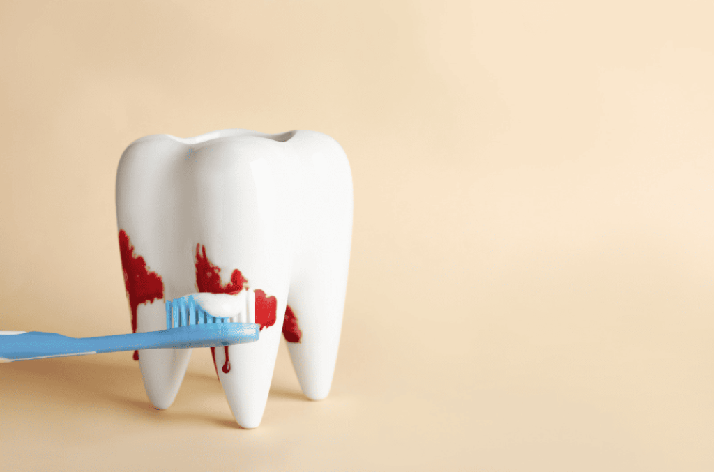 Gum Disease Causes Symptoms Treatment 牙周病成因 症狀 治療