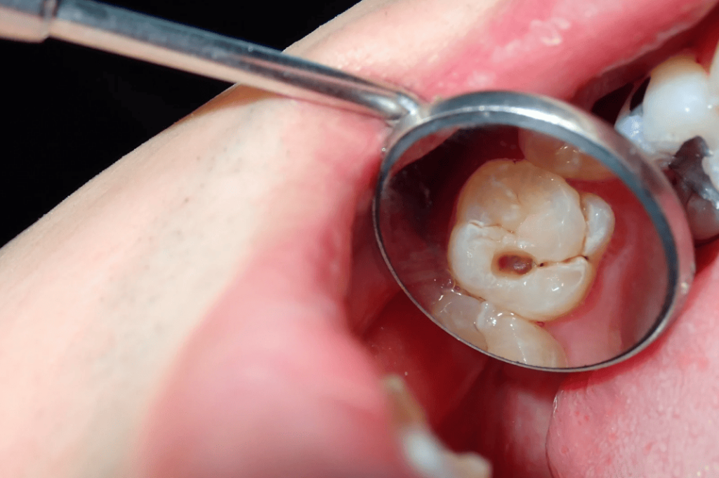 Identify Tooth Decay 處理蛀牙