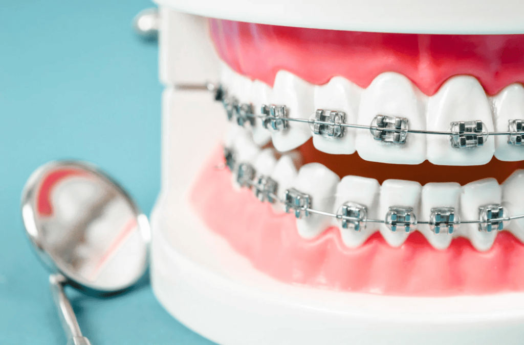 Metal Braces 金屬牙箍