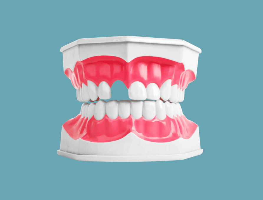 Missing Teeth Causes, Treatments, and Costs 甩牙原因,療程及價錢