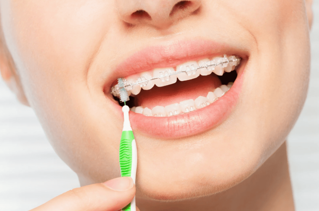 Oral Care During Treatment 箍牙時的口腔護理