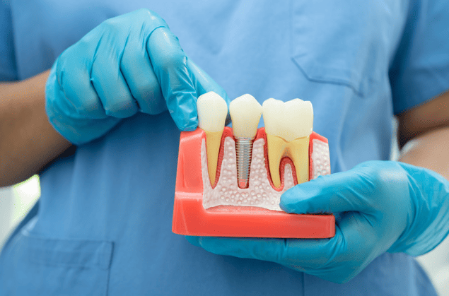 Root Canal Treatment 杜牙根 根管治療