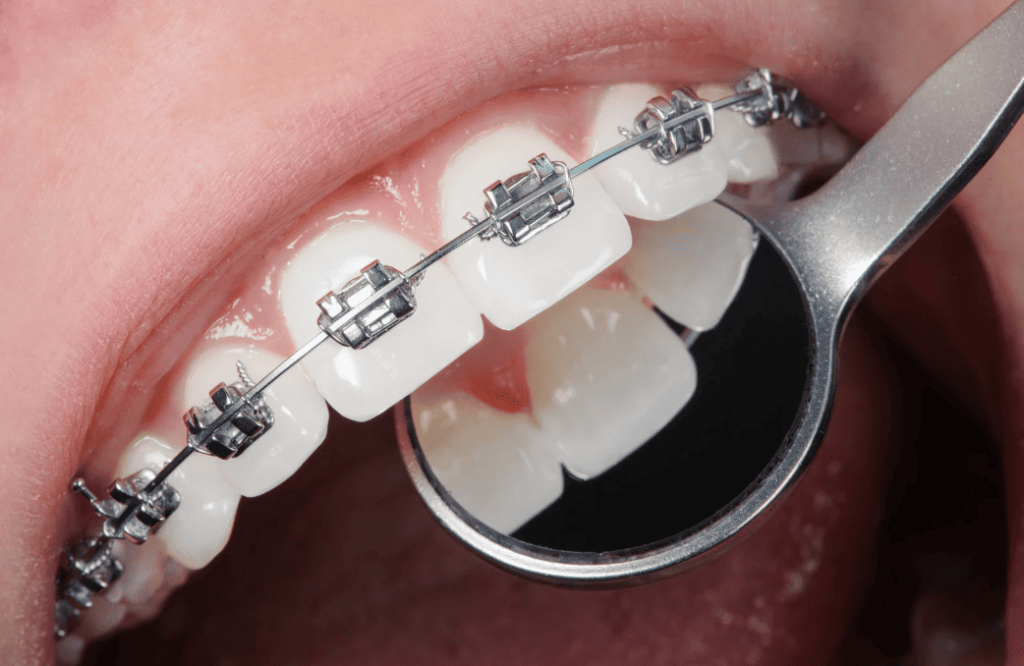 Self-Ligating Braces 自鎖式牙箍