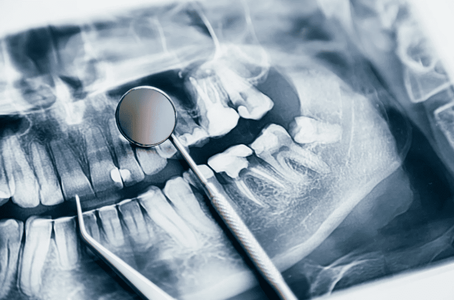 Treatments for Gum Swelling 牙肉腫痛解決方法
