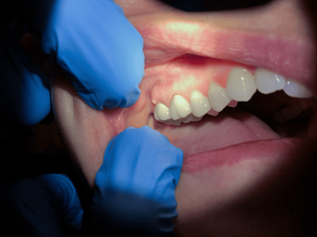 Types of Dental Abscesses 牙瘡的種類